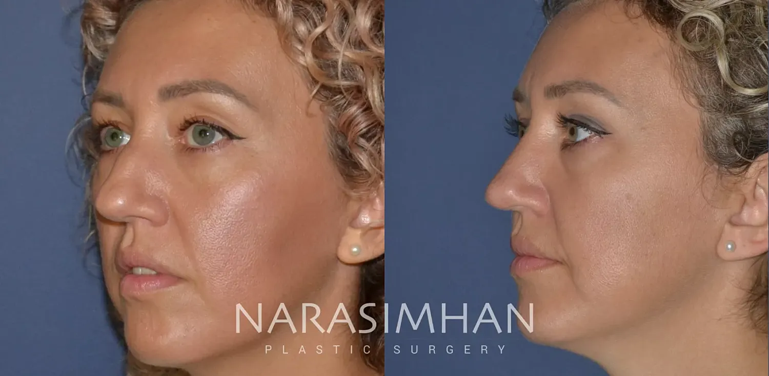 Ethnic Rhinoplasty Before & After