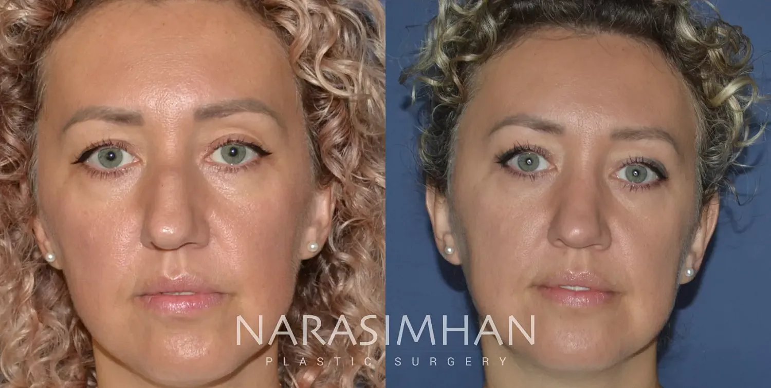 Ethnic Rhinoplasty Before & After