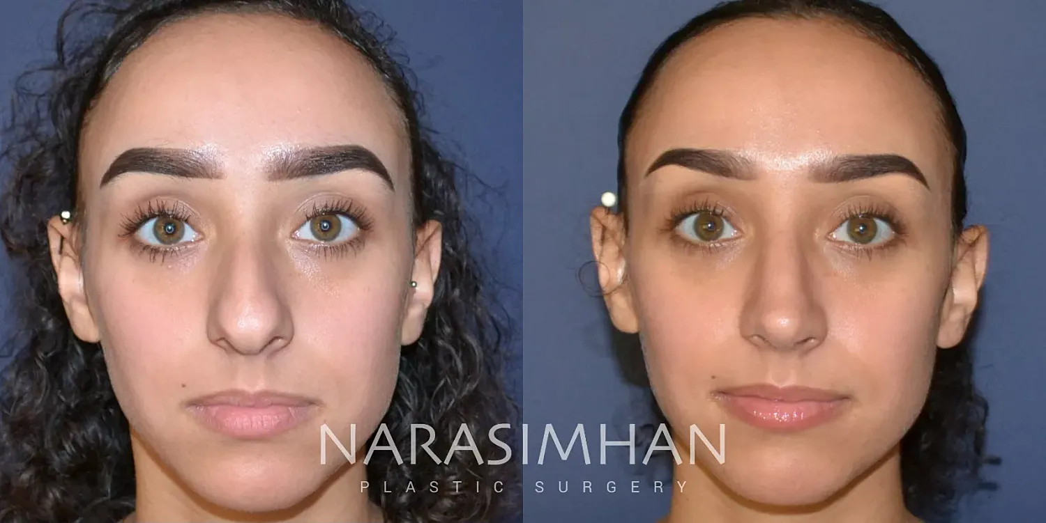 Ethnic Rhinoplasty Before & After