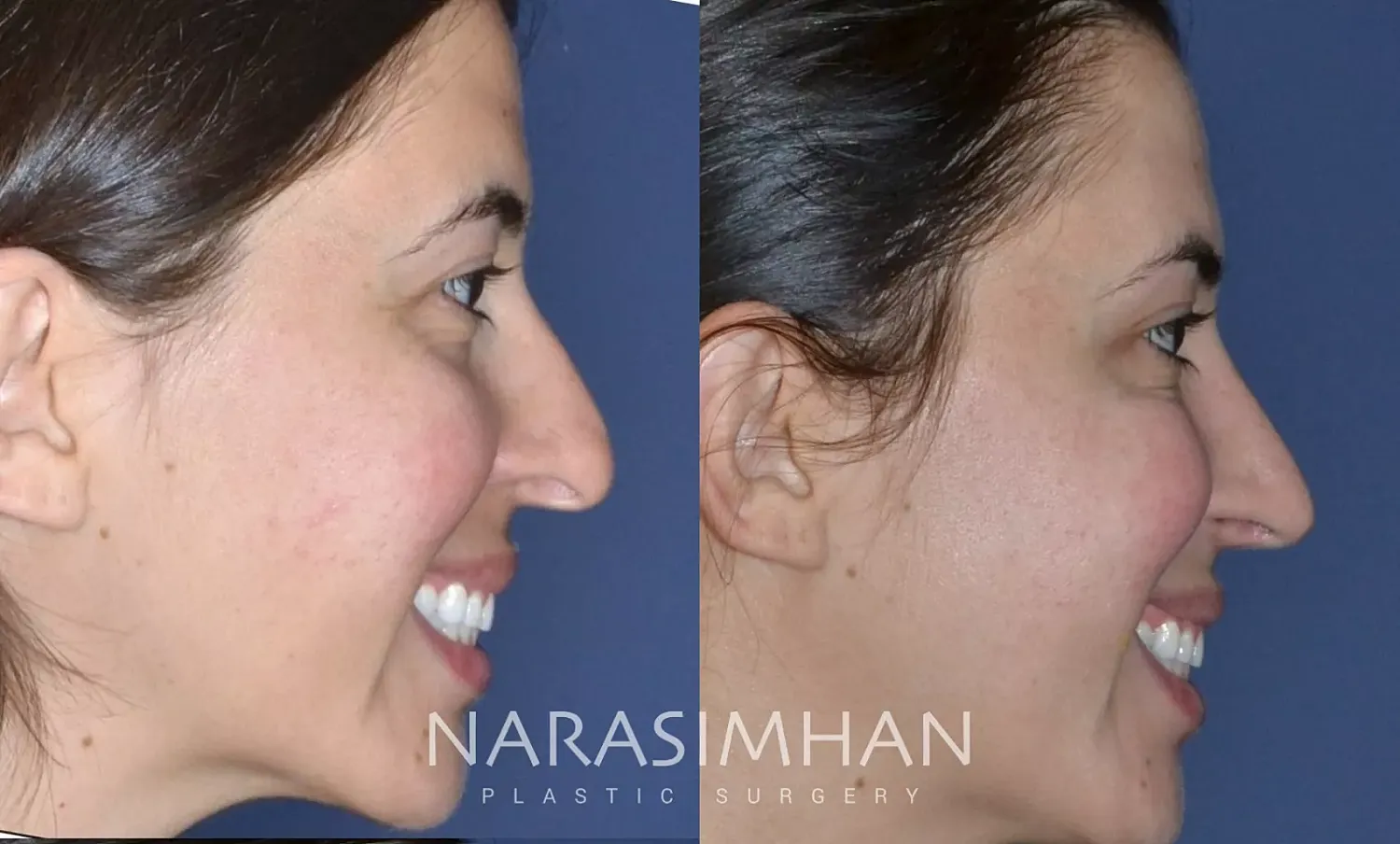 Ethnic Rhinoplasty Before & After