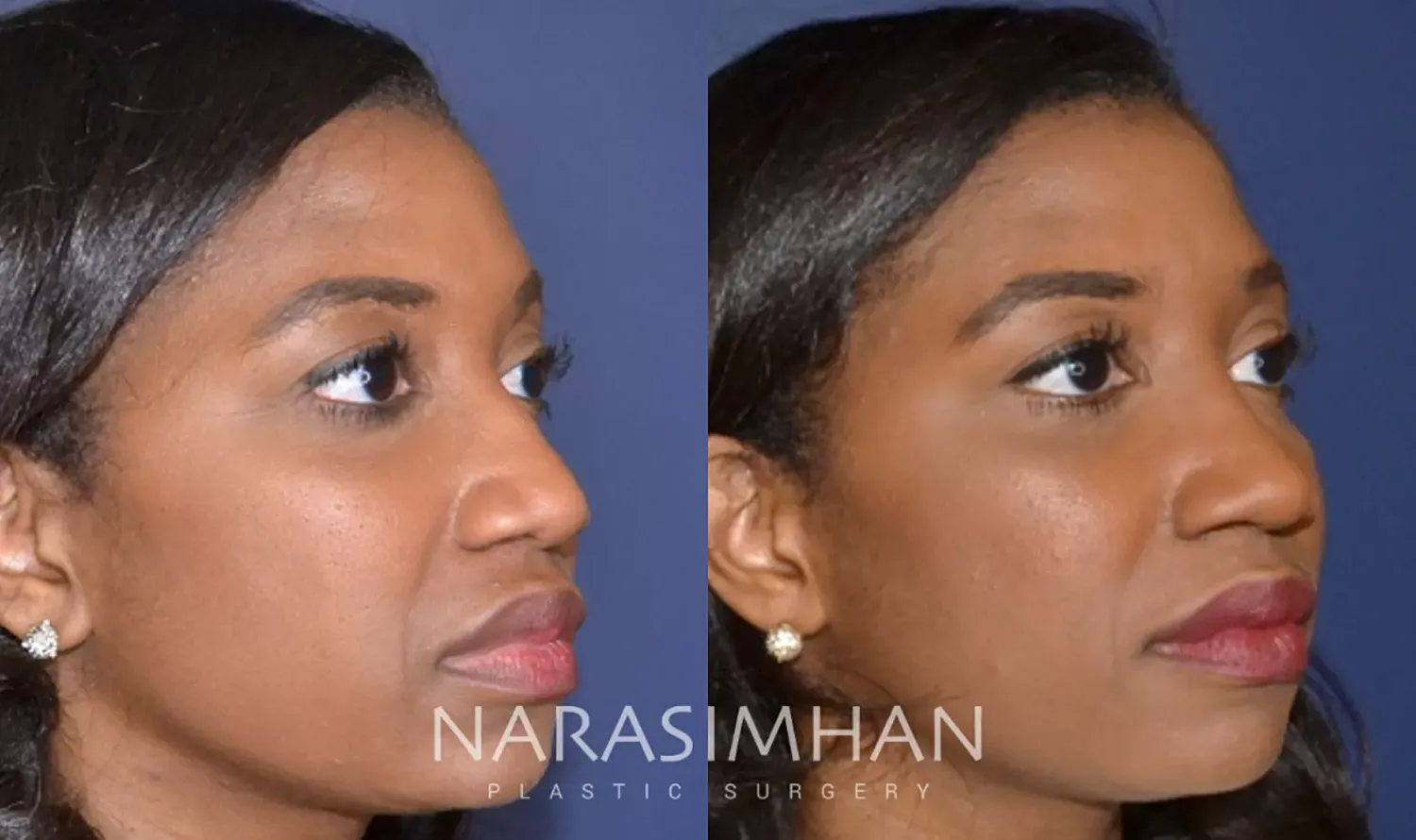 Ethnic Rhinoplasty Before & After