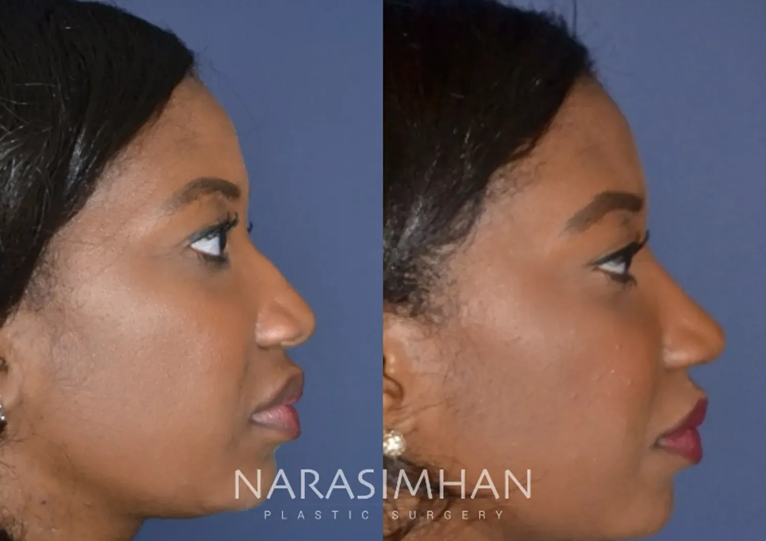 Ethnic Rhinoplasty Before & After