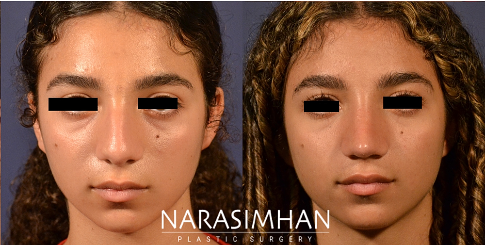 Ethnic Rhinoplasty Before & After