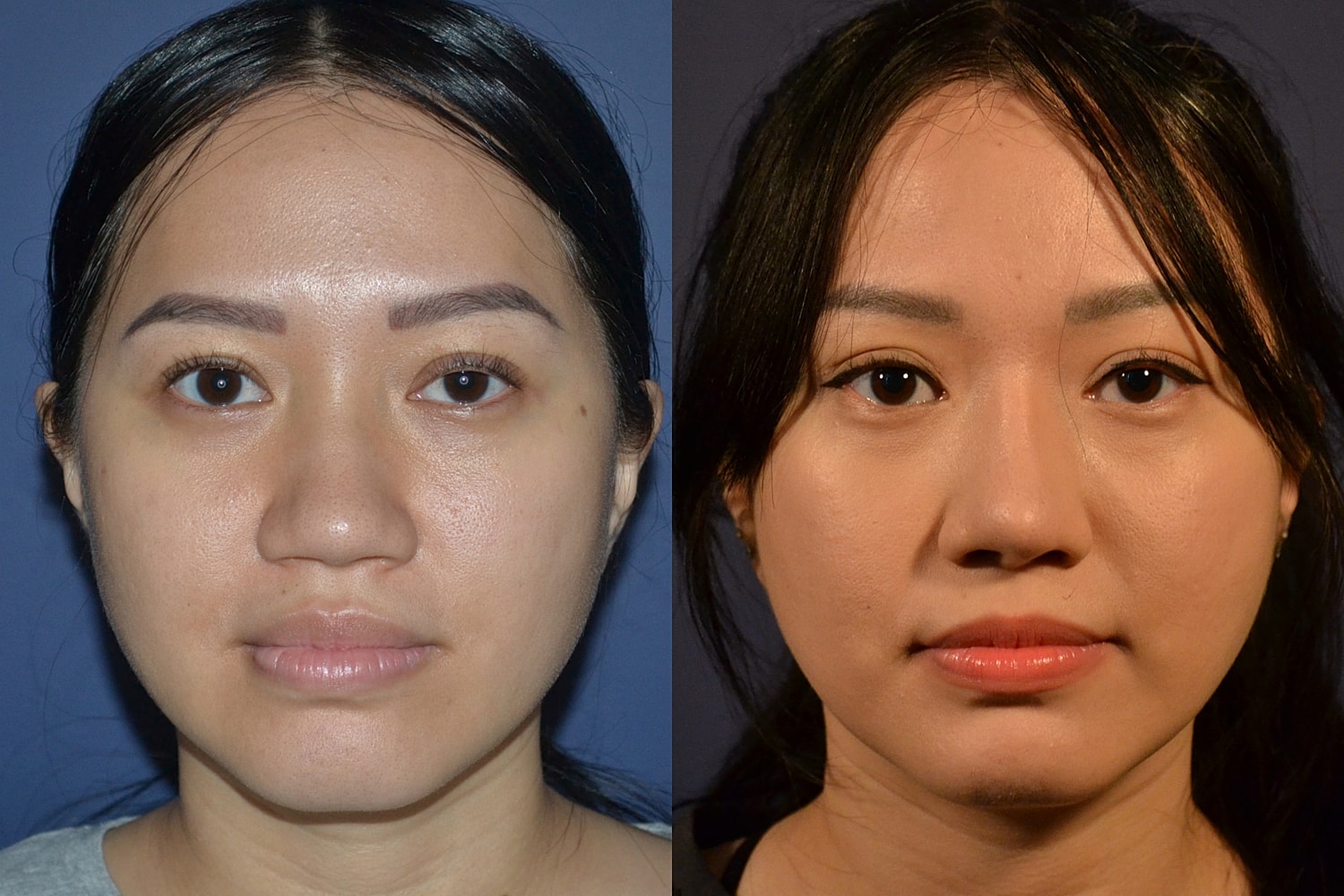 Before and after facial treatment comparison image.