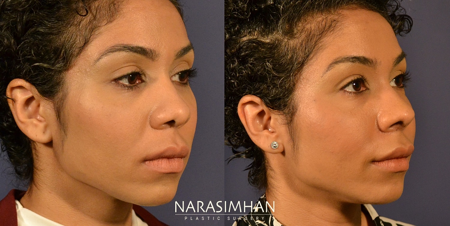 Ethnic Rhinoplasty  Before & After