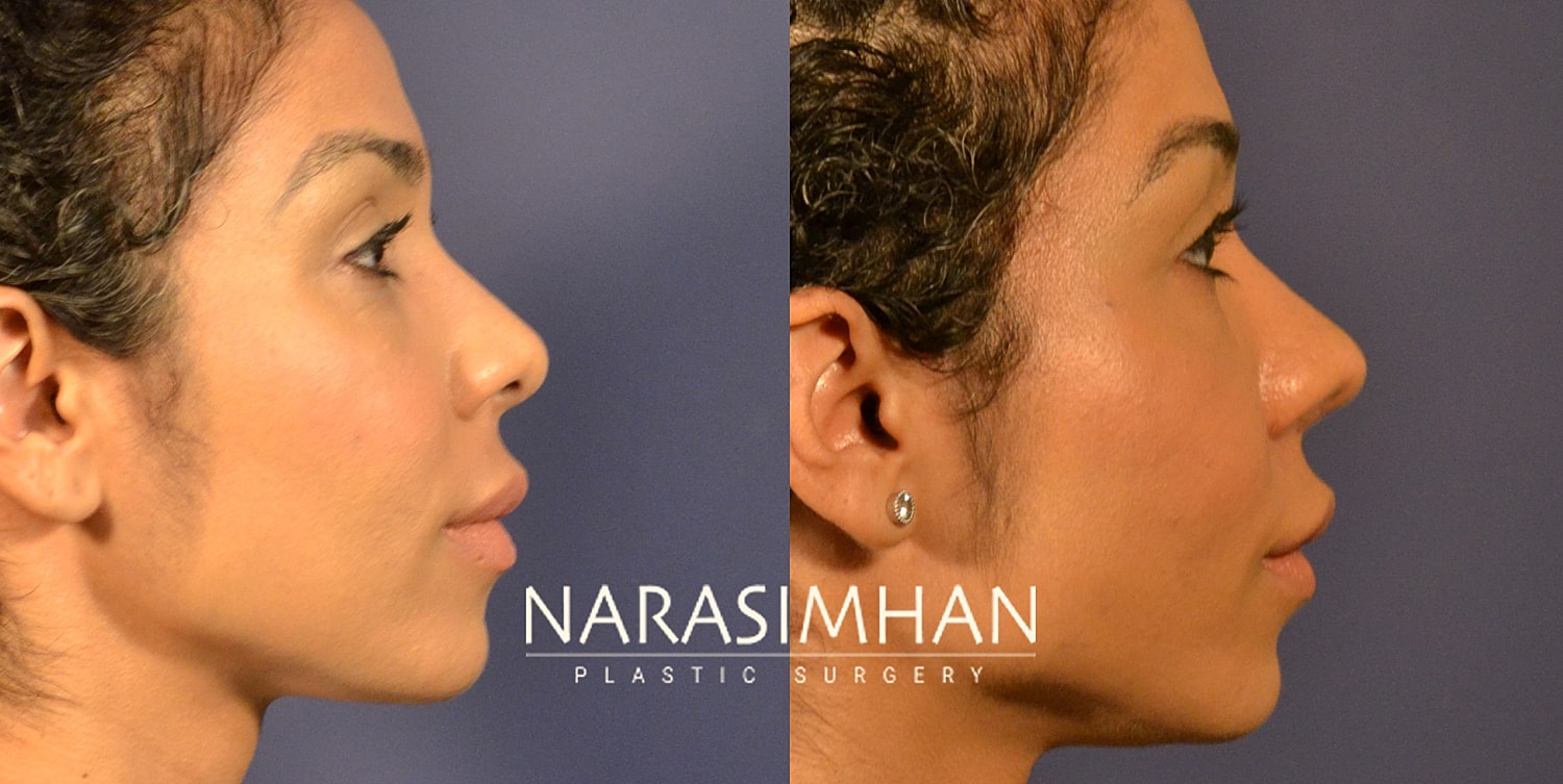 Ethnic Rhinoplasty  Before & After