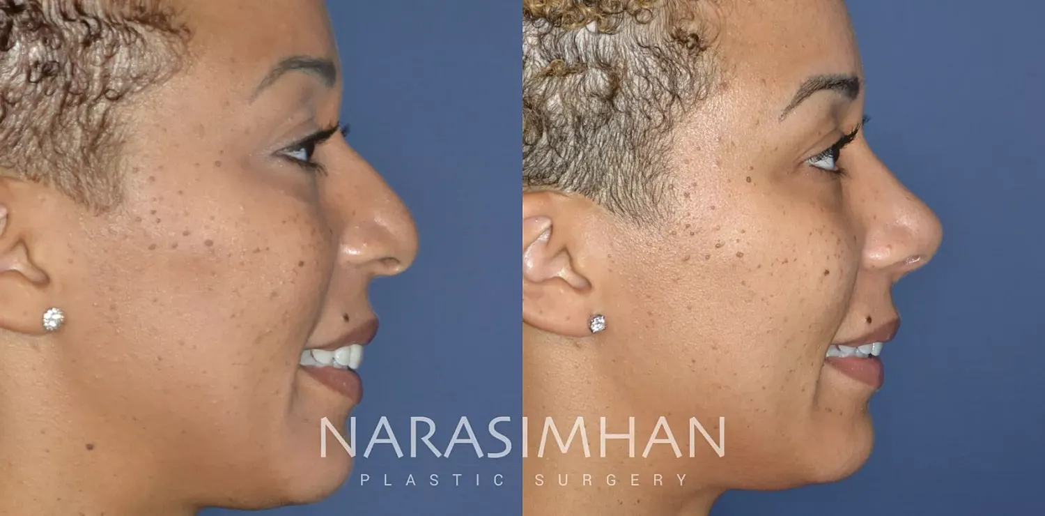 Ethnic Rhinoplasty  Before & After