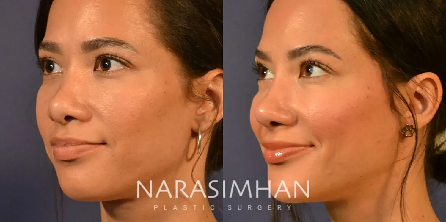Ethnic Rhinoplasty  Before & After