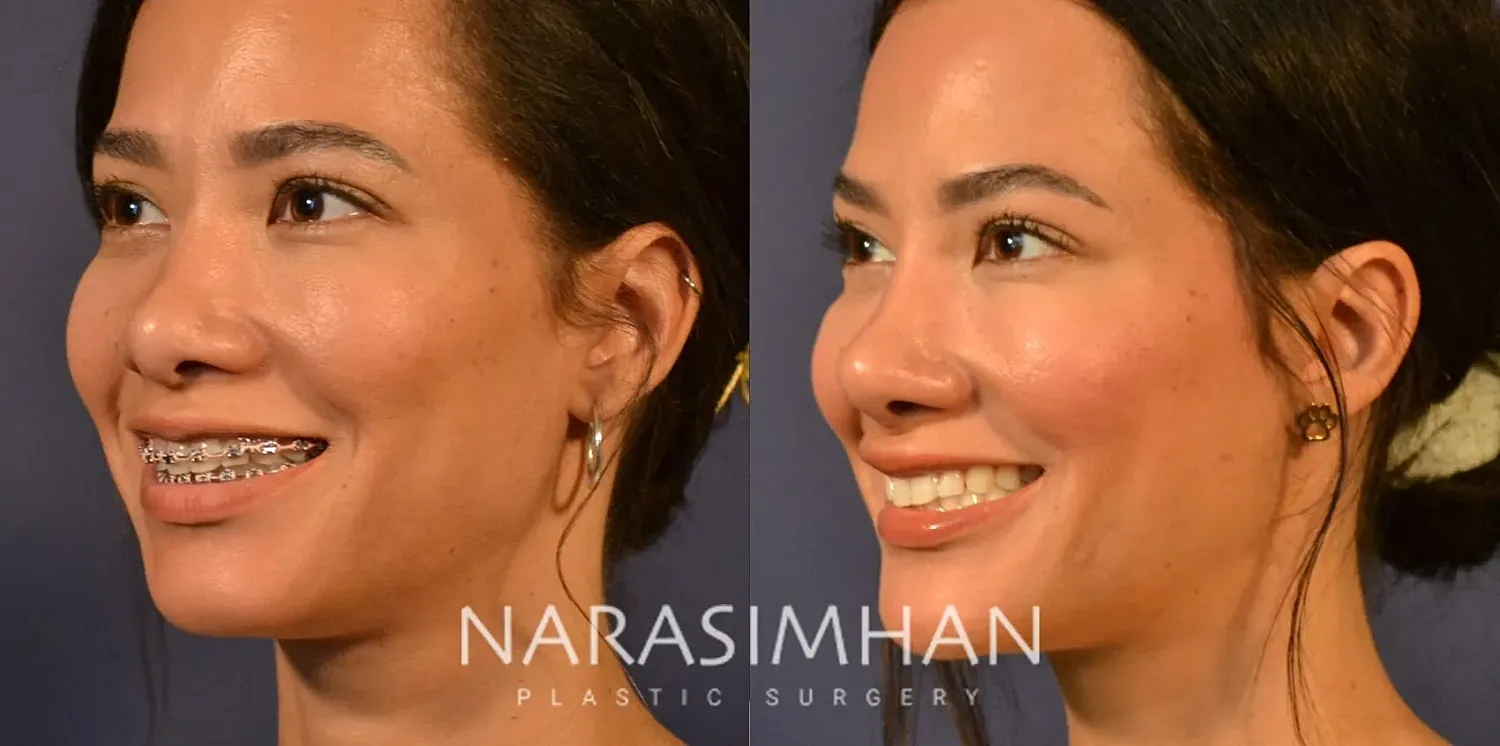 Ethnic Rhinoplasty  Before & After