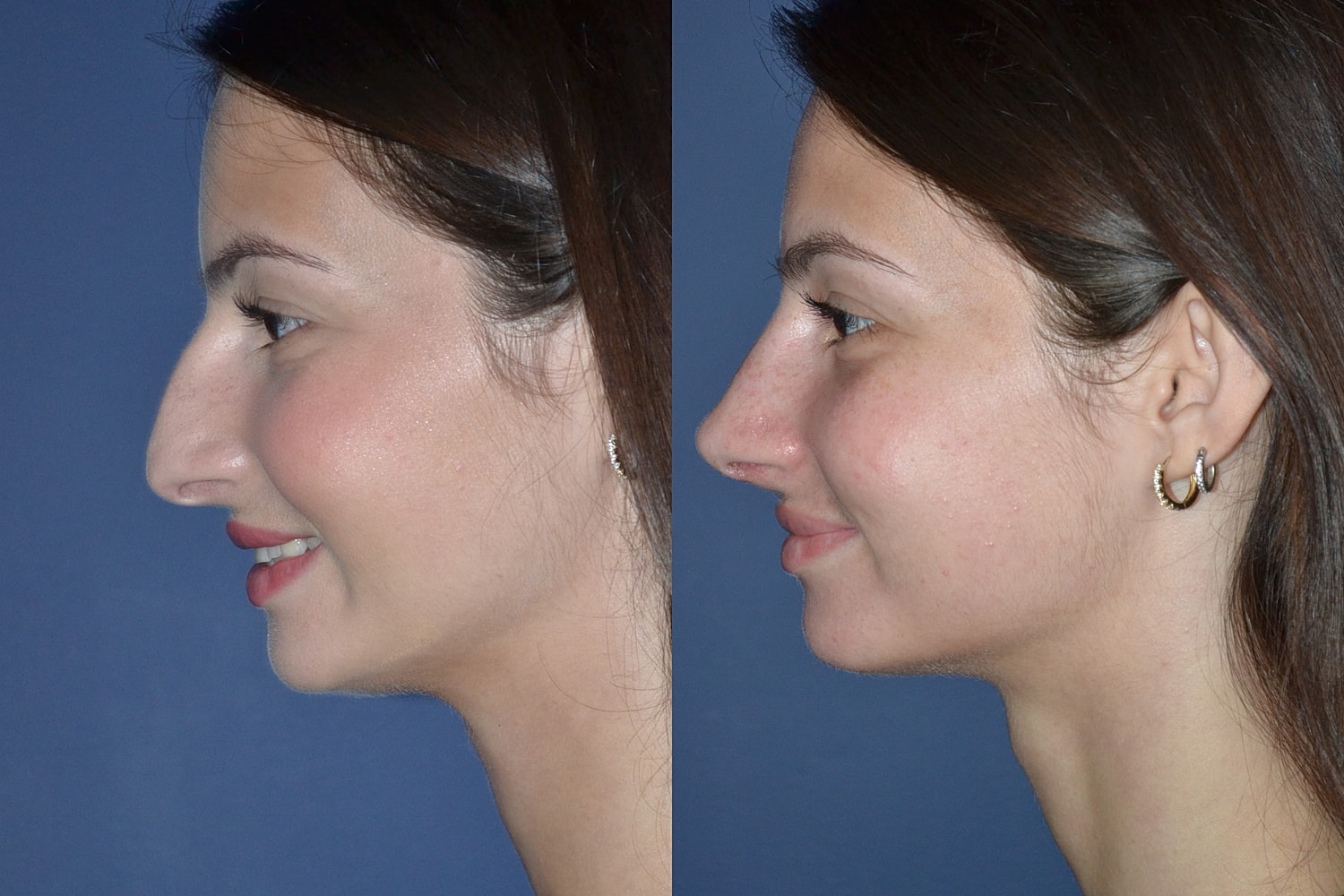 Ethnic Rhinoplasty  Before & After