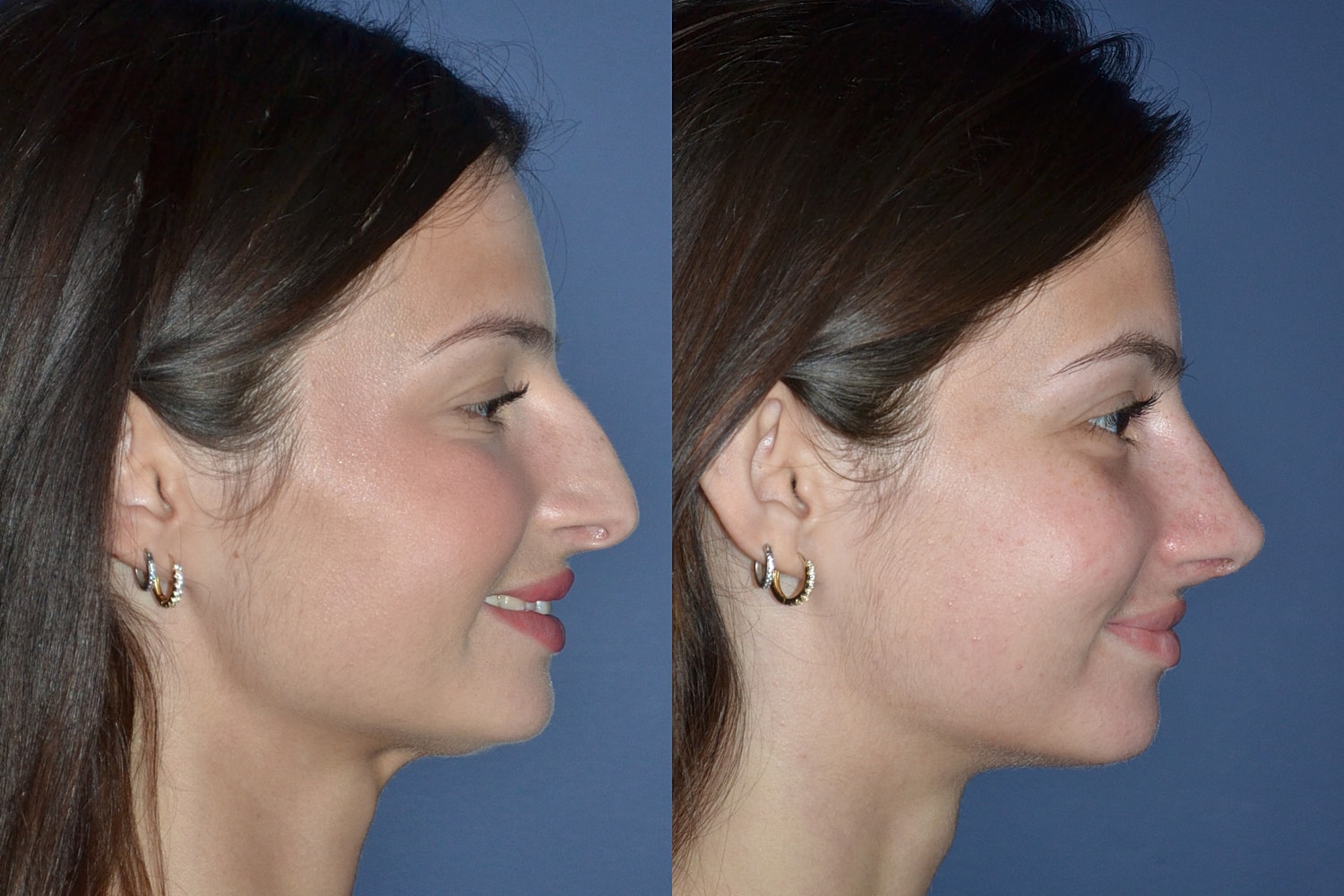 Ethnic Rhinoplasty  Before & After