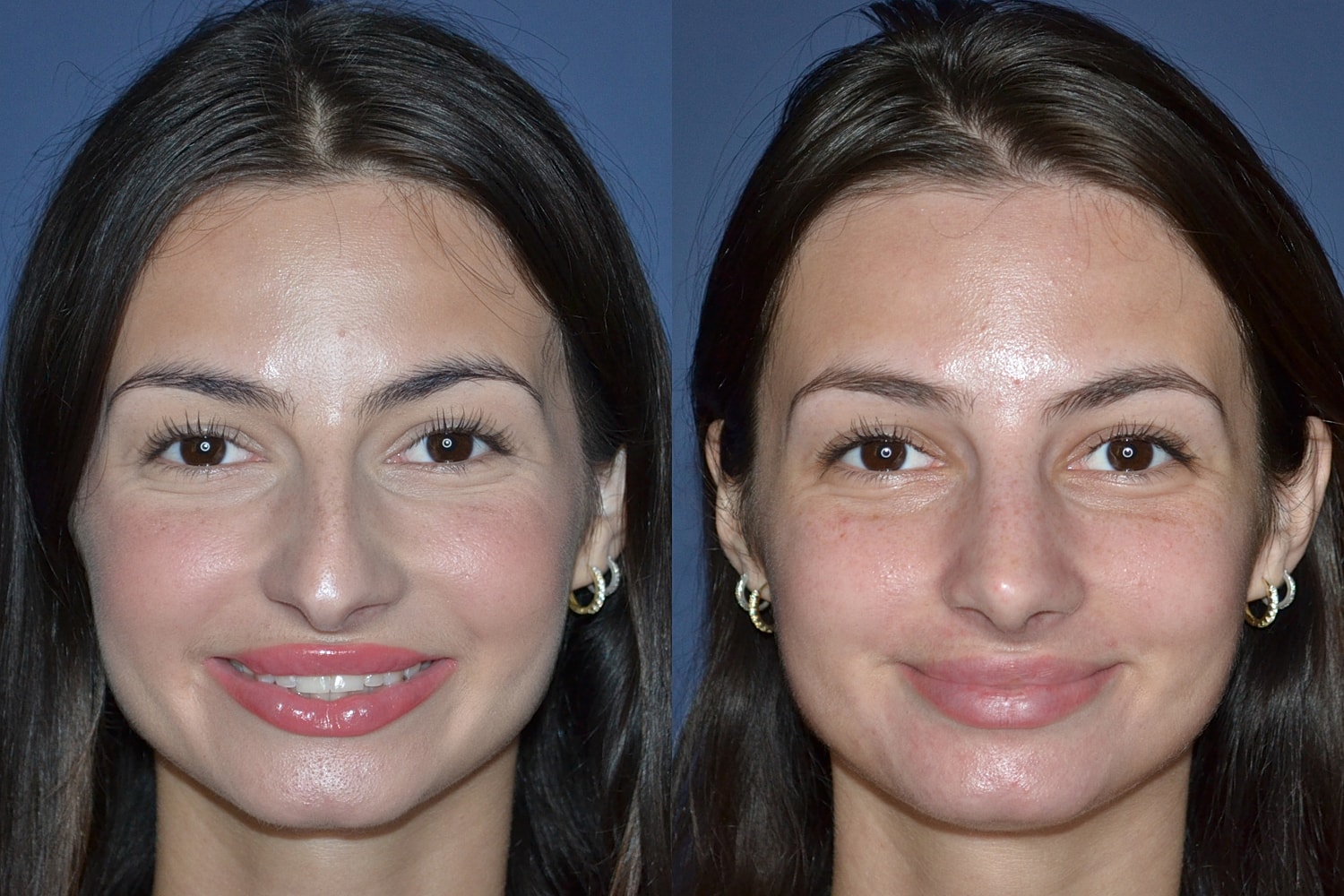 Ethnic Rhinoplasty  Before & After
