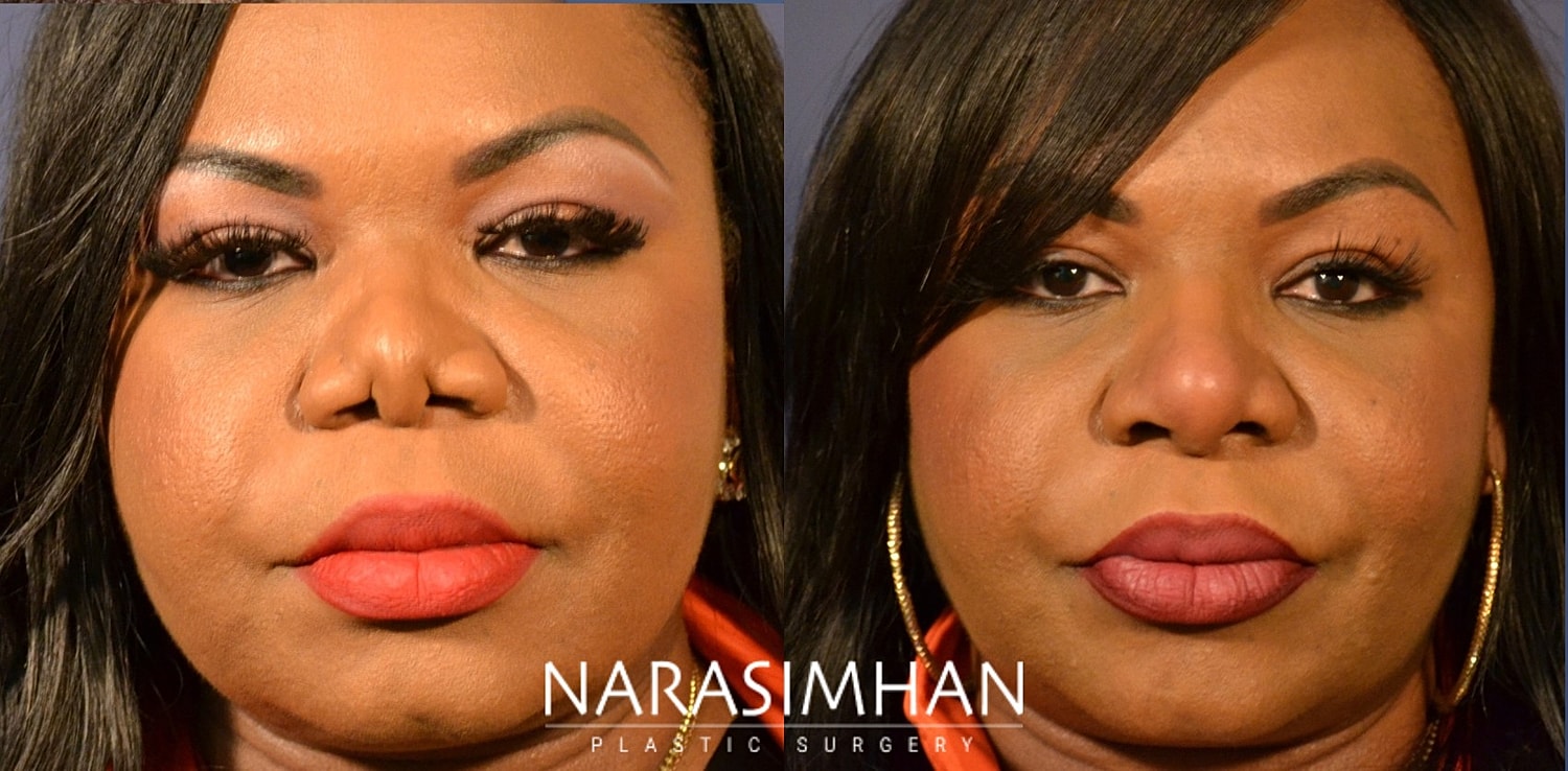 Ethnic Rhinoplasty  Before & After