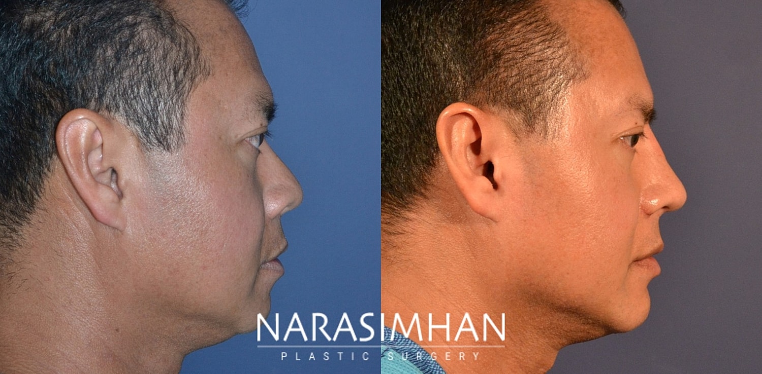 Ethnic Rhinoplasty  Before & After