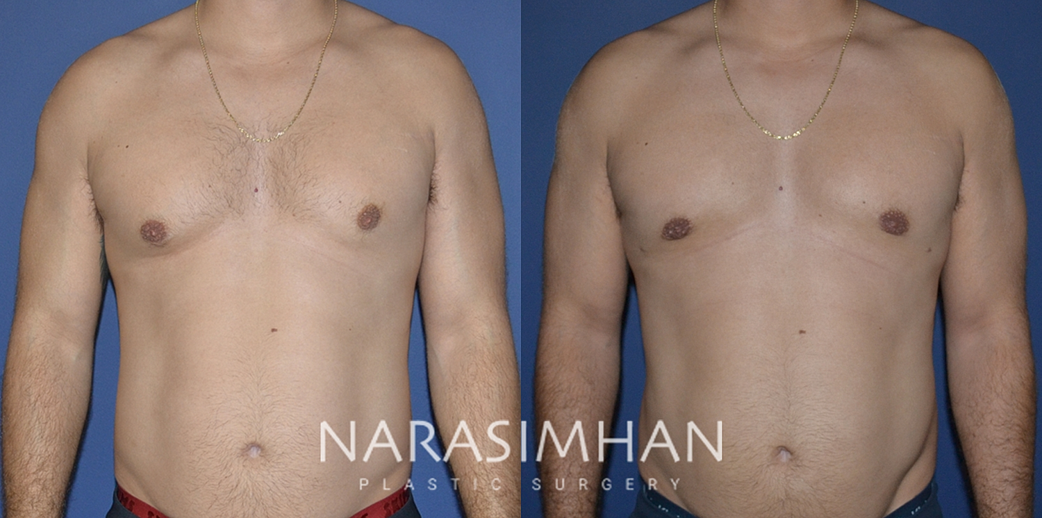 Body Contouring Before & After