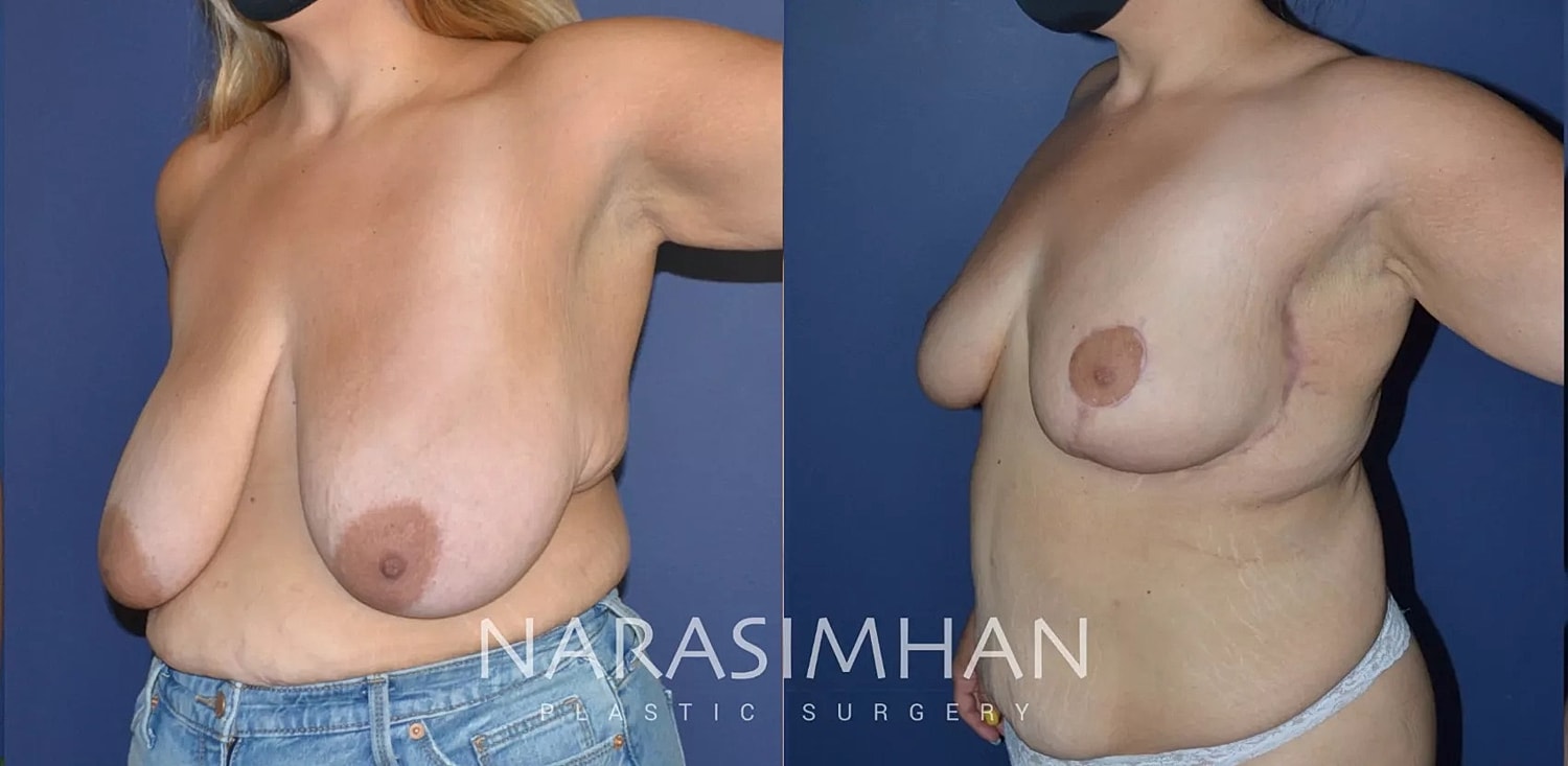 Body Contouring Before & After
