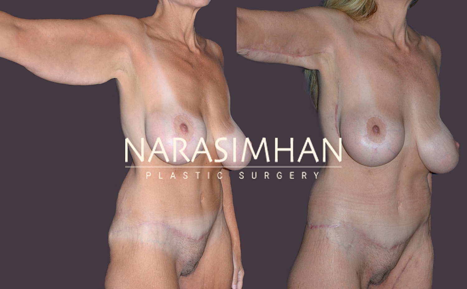 Body Contouring Before & After