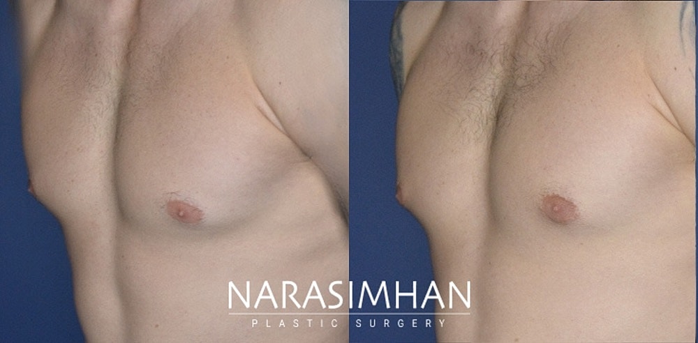 Body Contouring Before & After