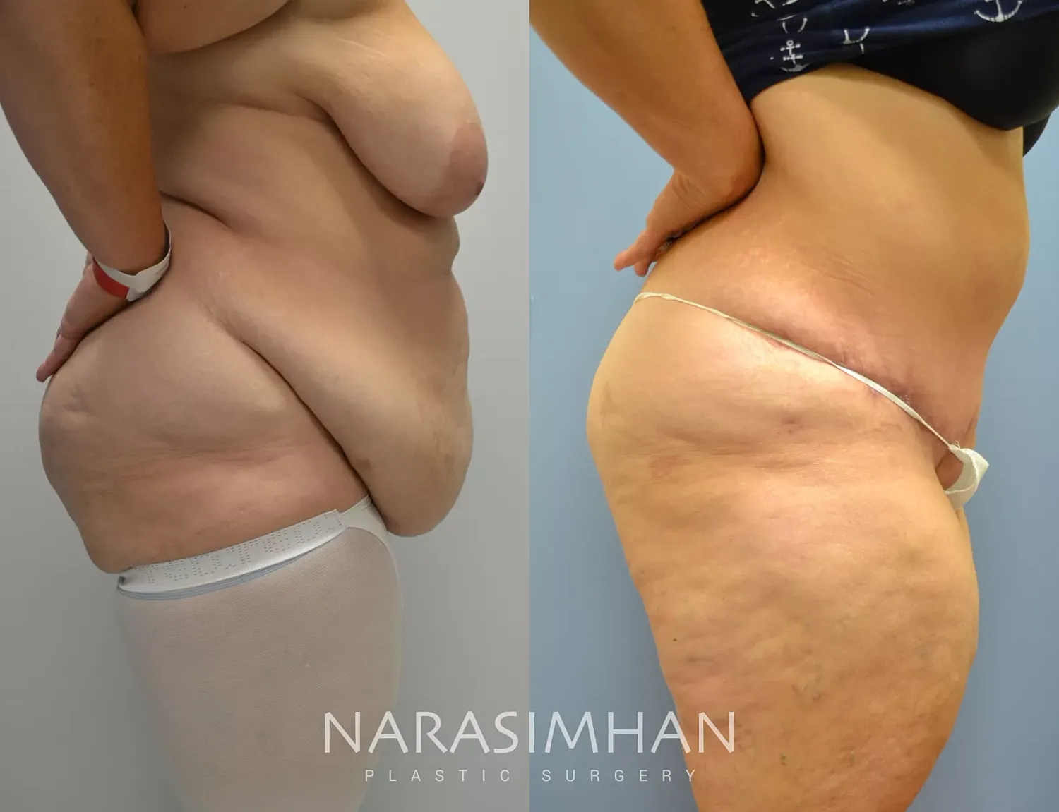 Body Contouring Before & After