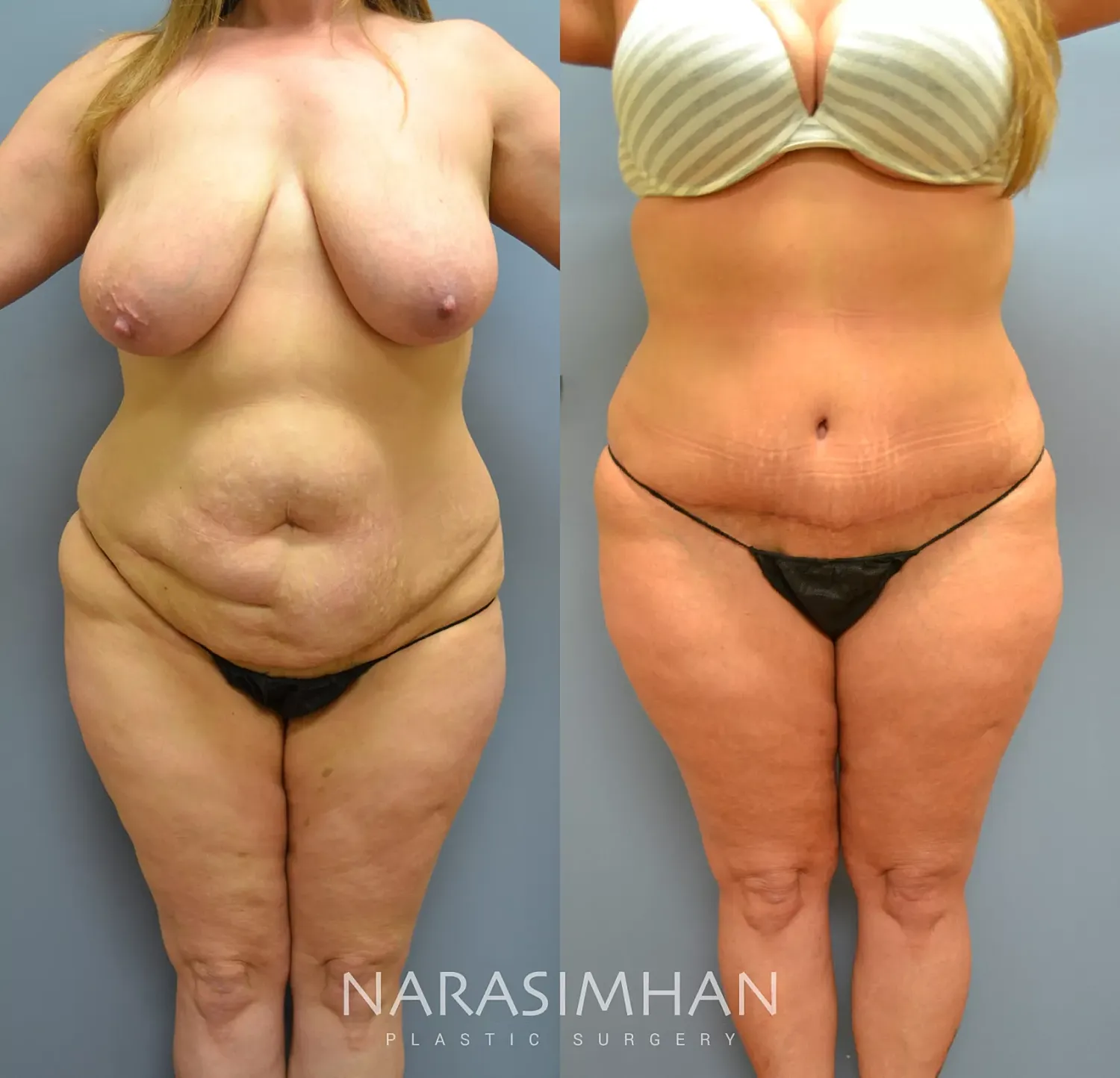 Body Contouring Before & After