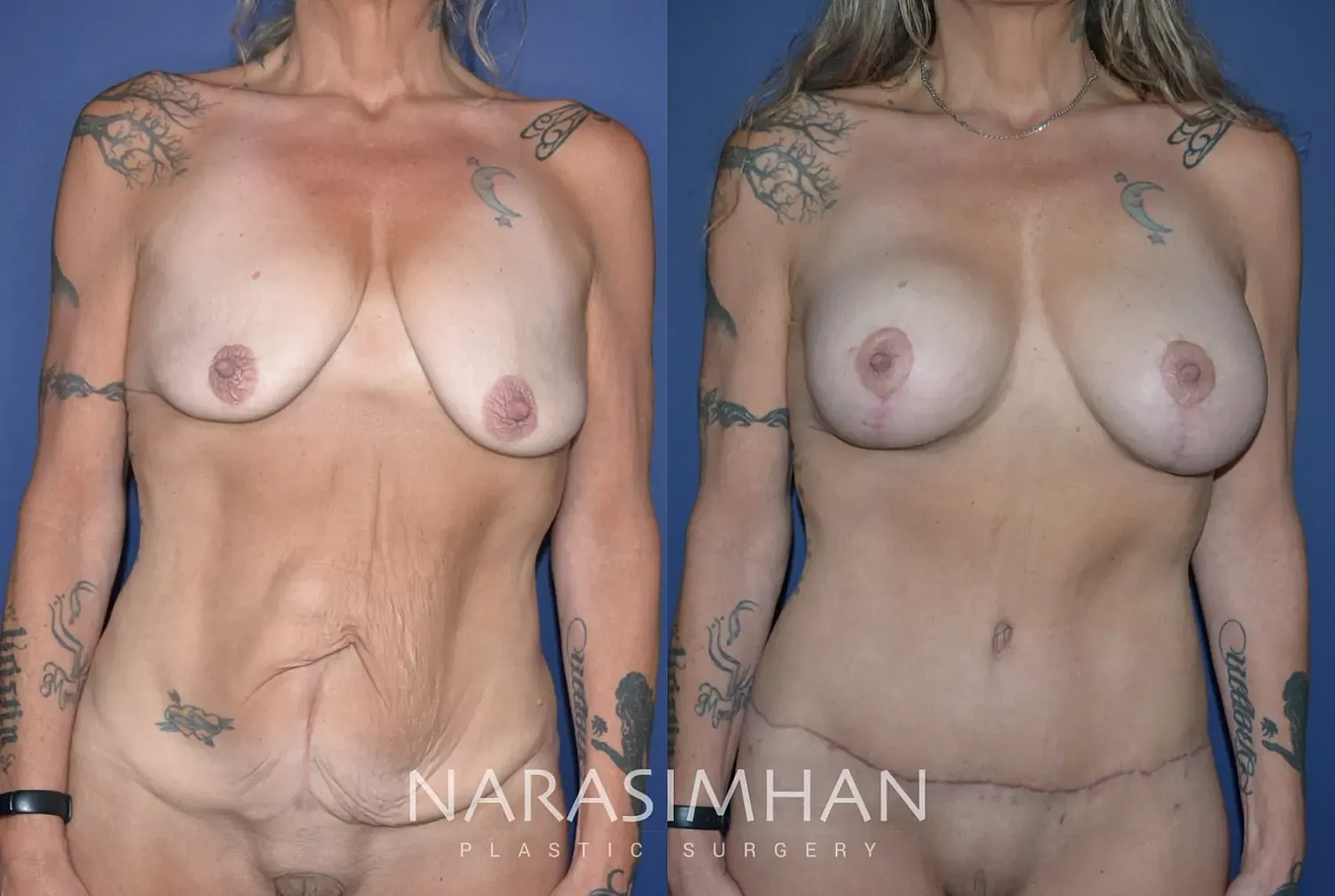 Body Contouring Before & After