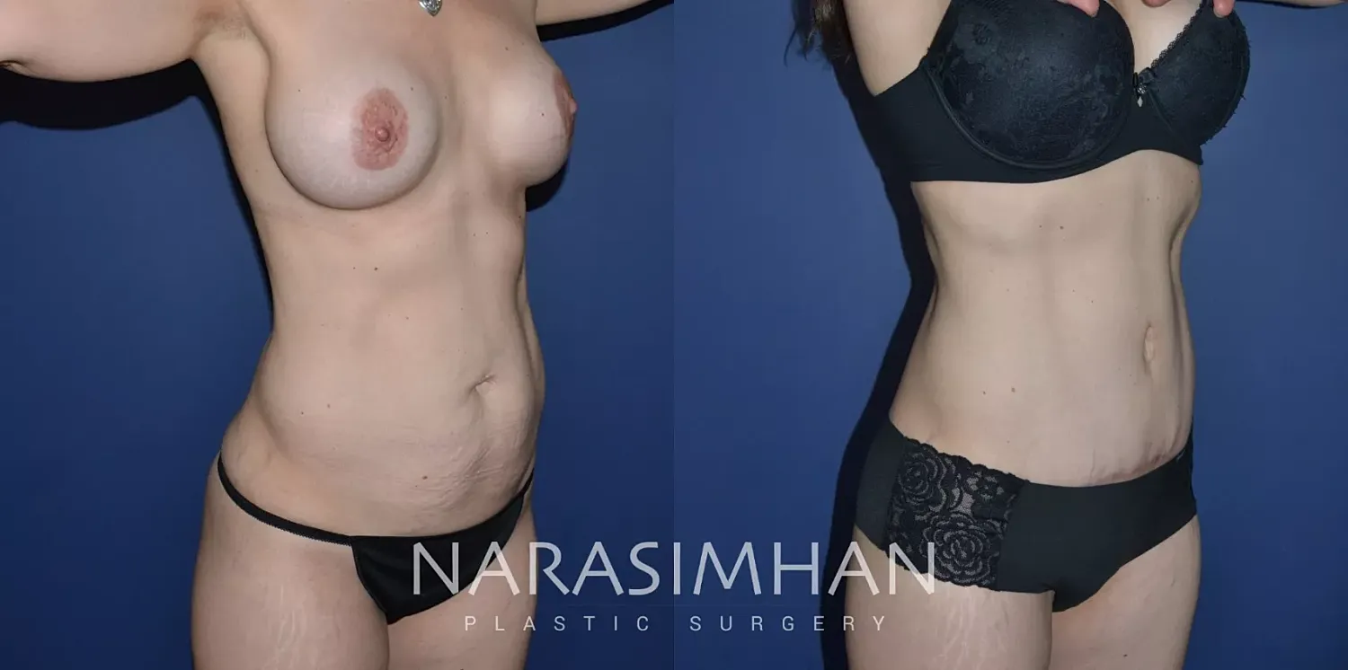 Body Contouring Before & After