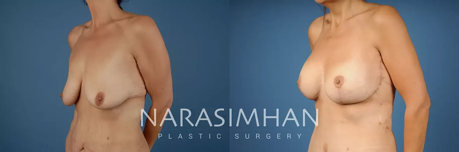 Body Contouring Before & After