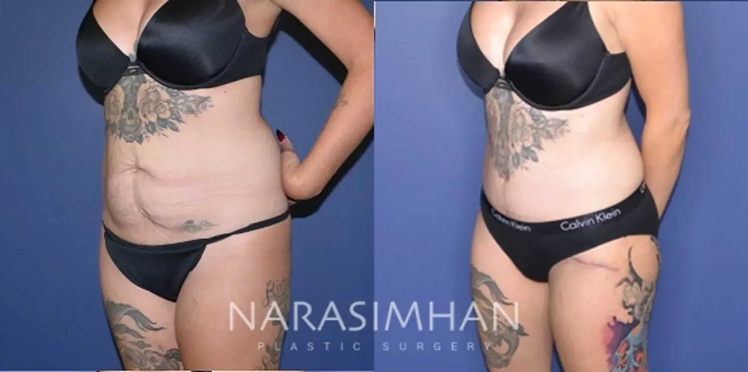 Body Contouring Before & After