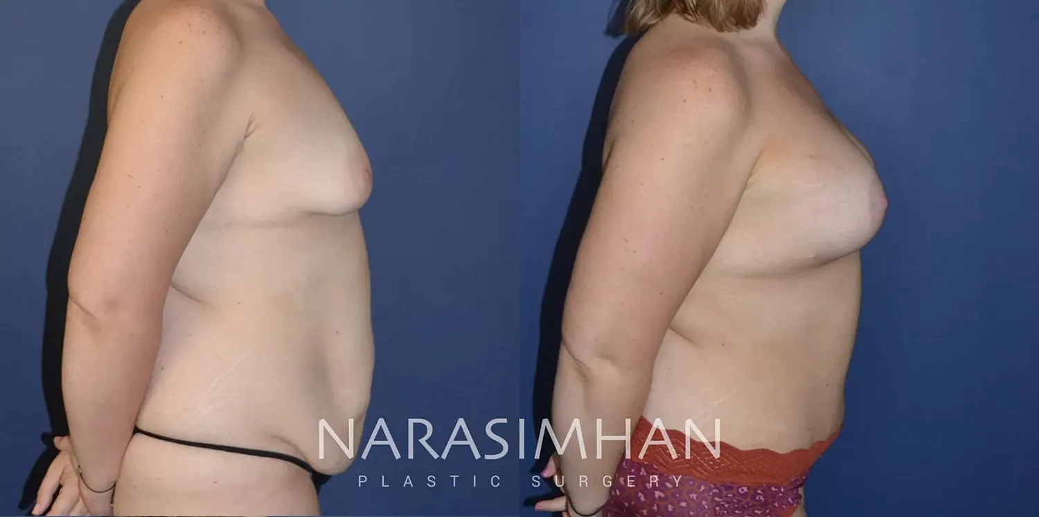 Body Contouring Before & After