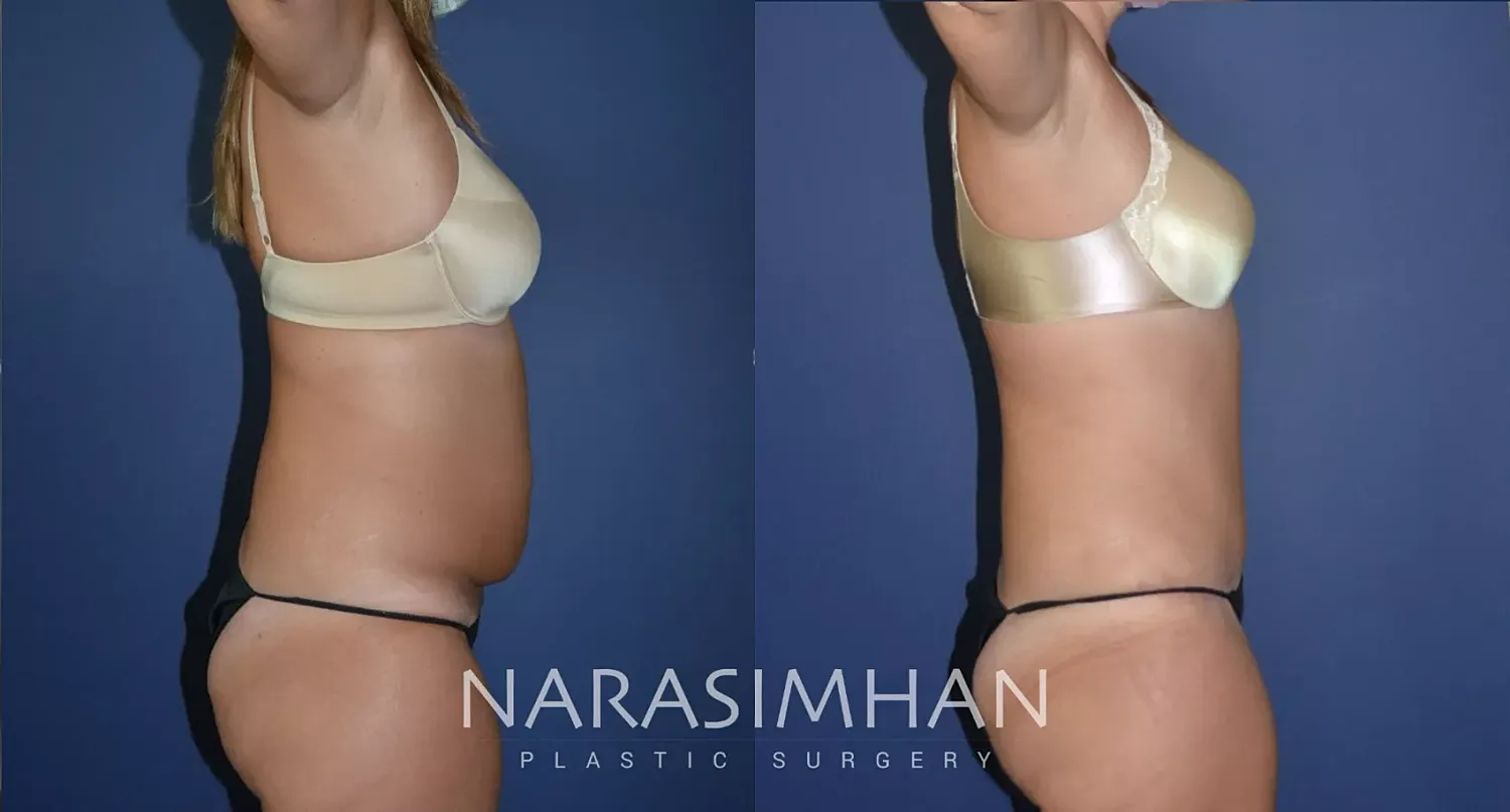 Body Contouring Before & After