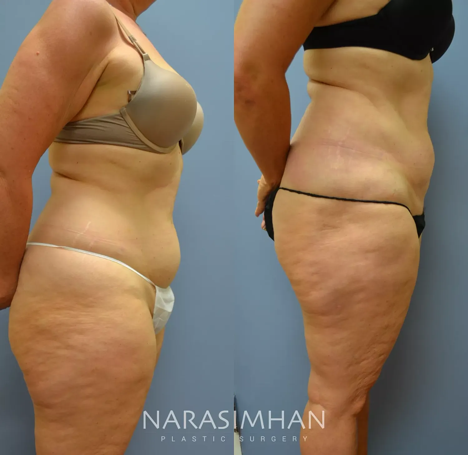 Body Contouring Before & After