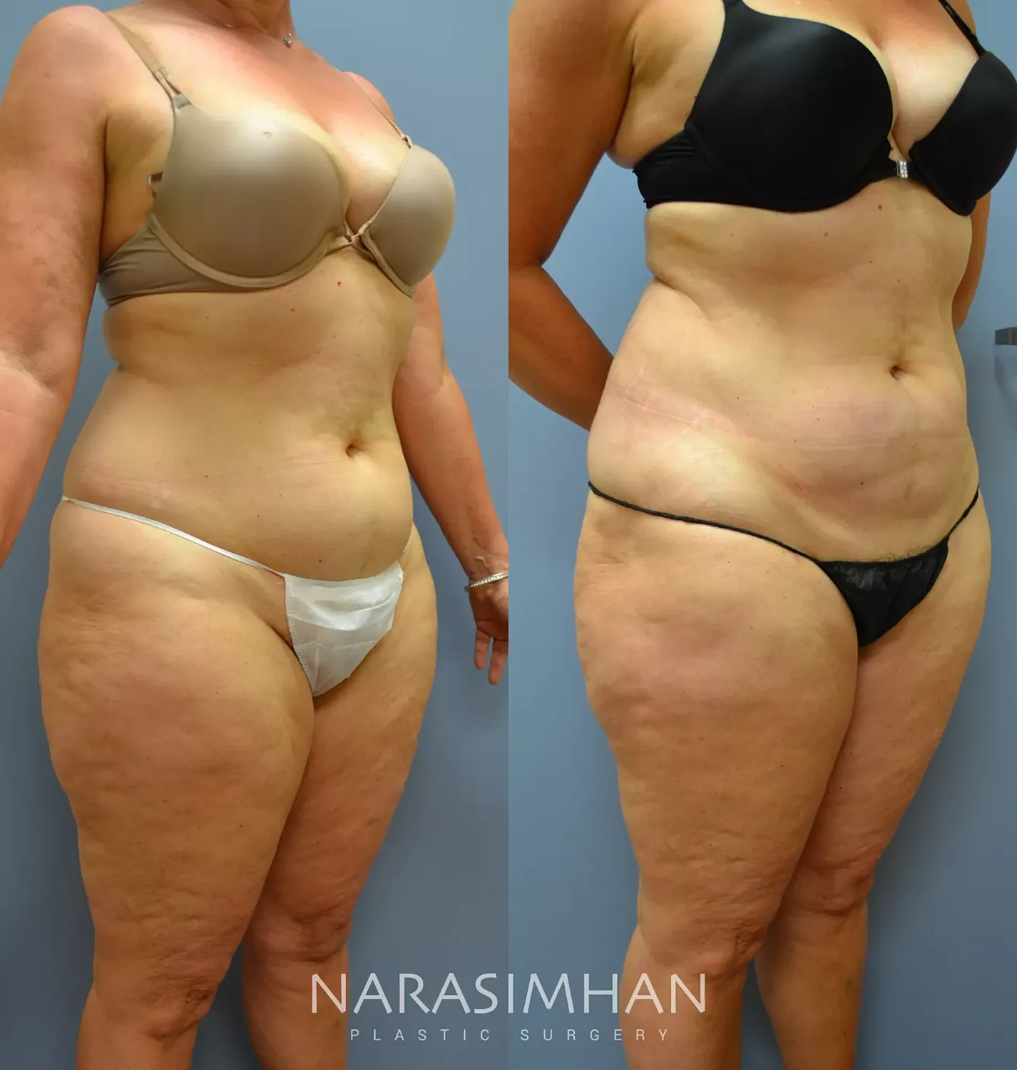Body Contouring Before & After