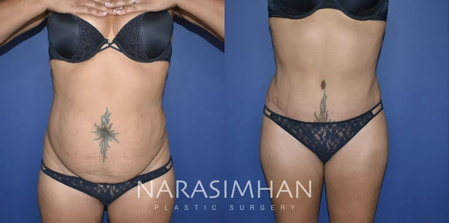 Body Contouring Before & After