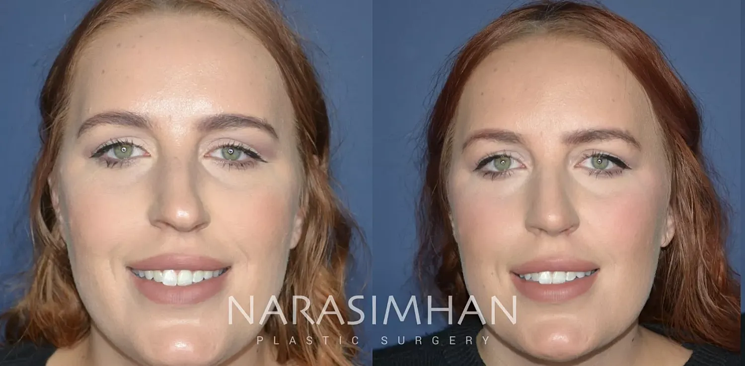 Body Contouring Before & After