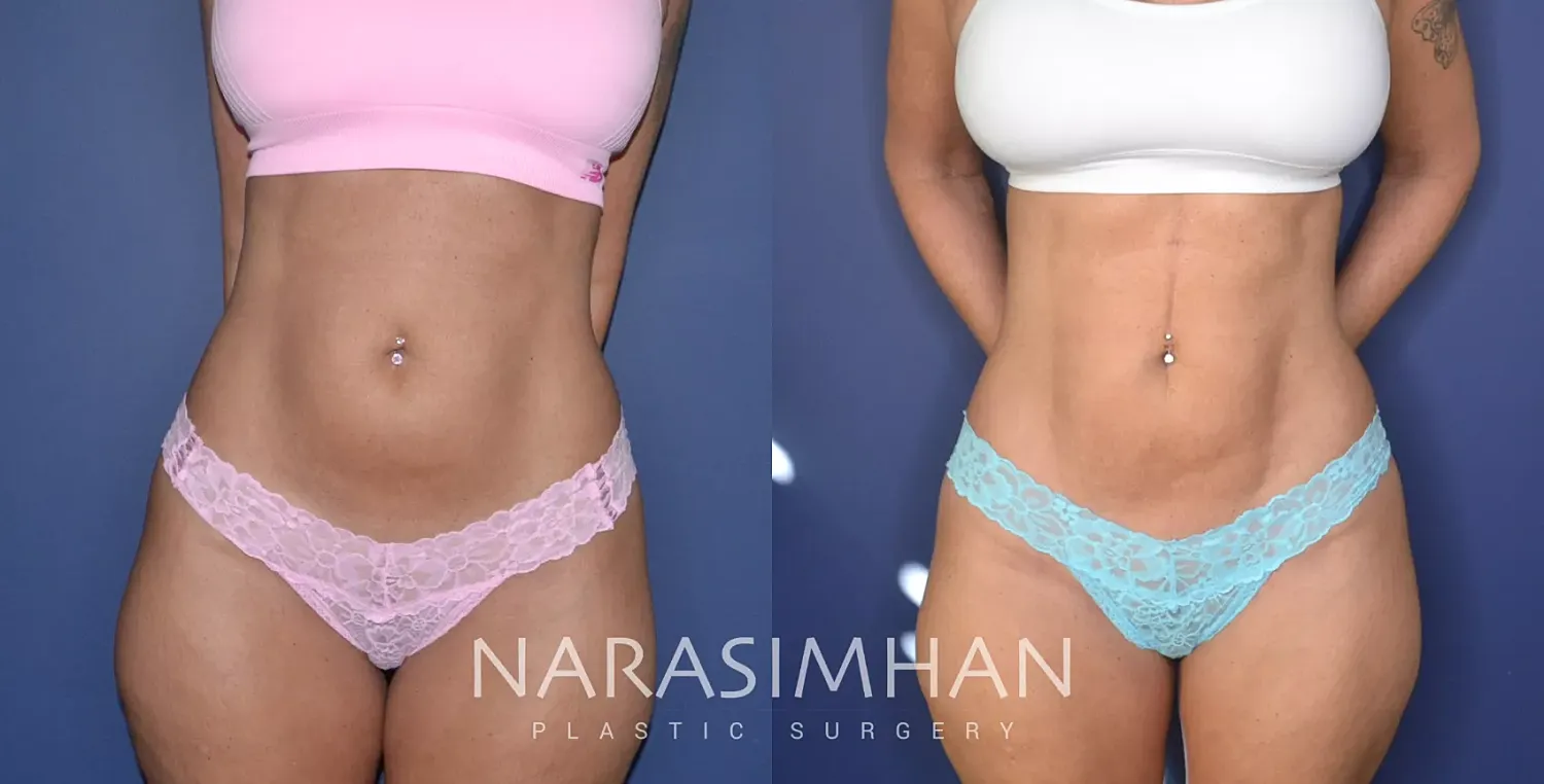 Body Contouring Before & After