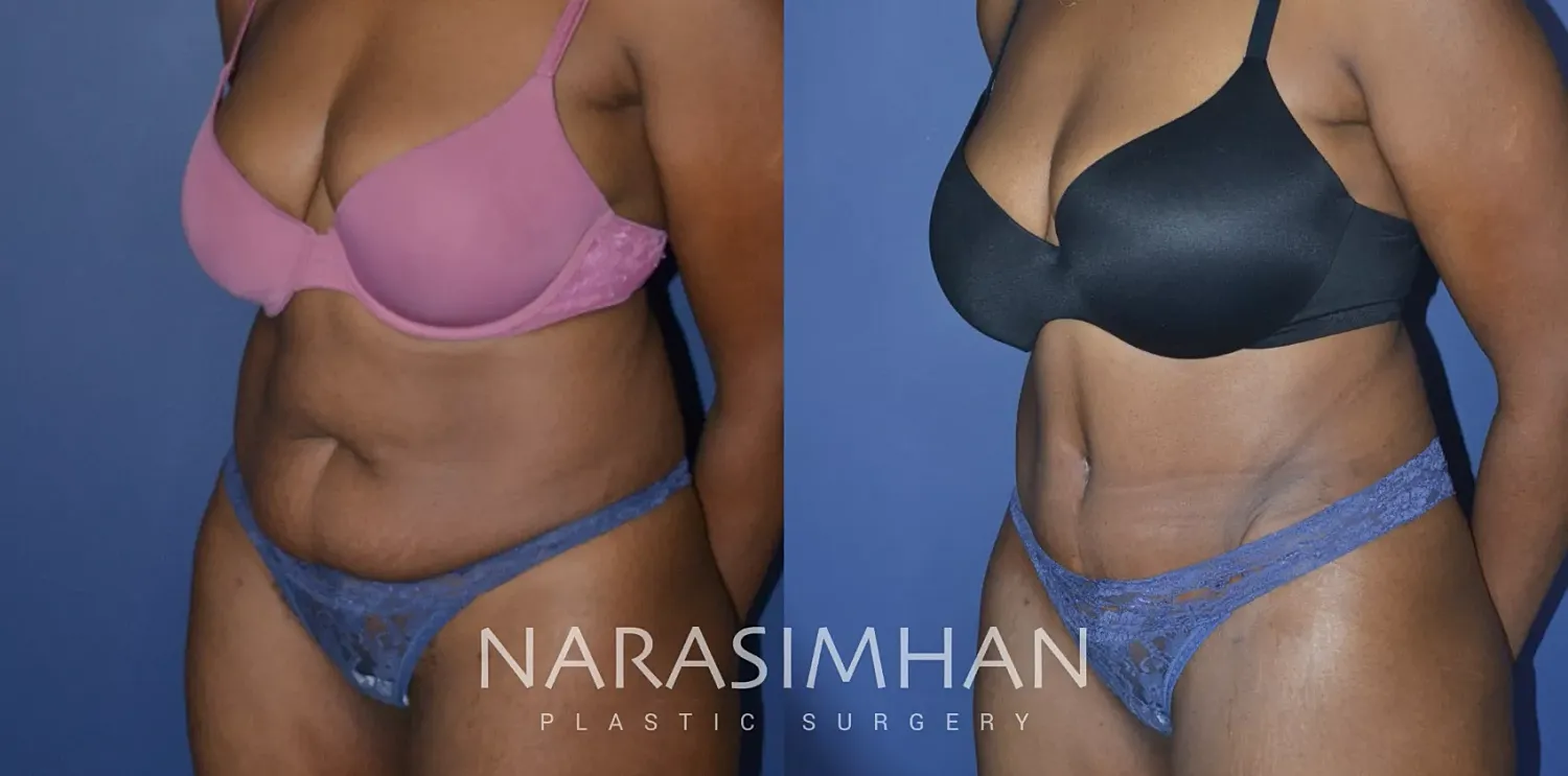Body Contouring Before & After