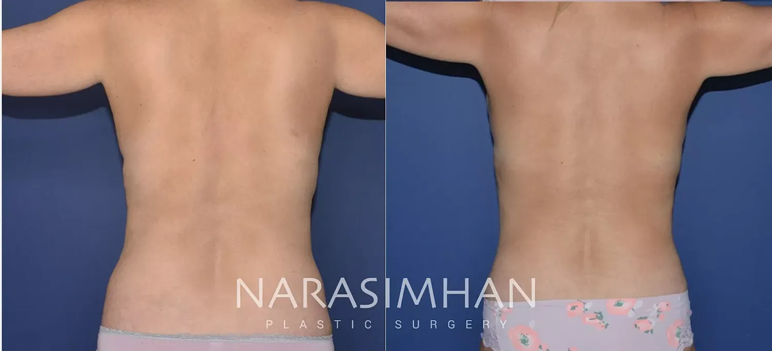 Body Contouring Before & After