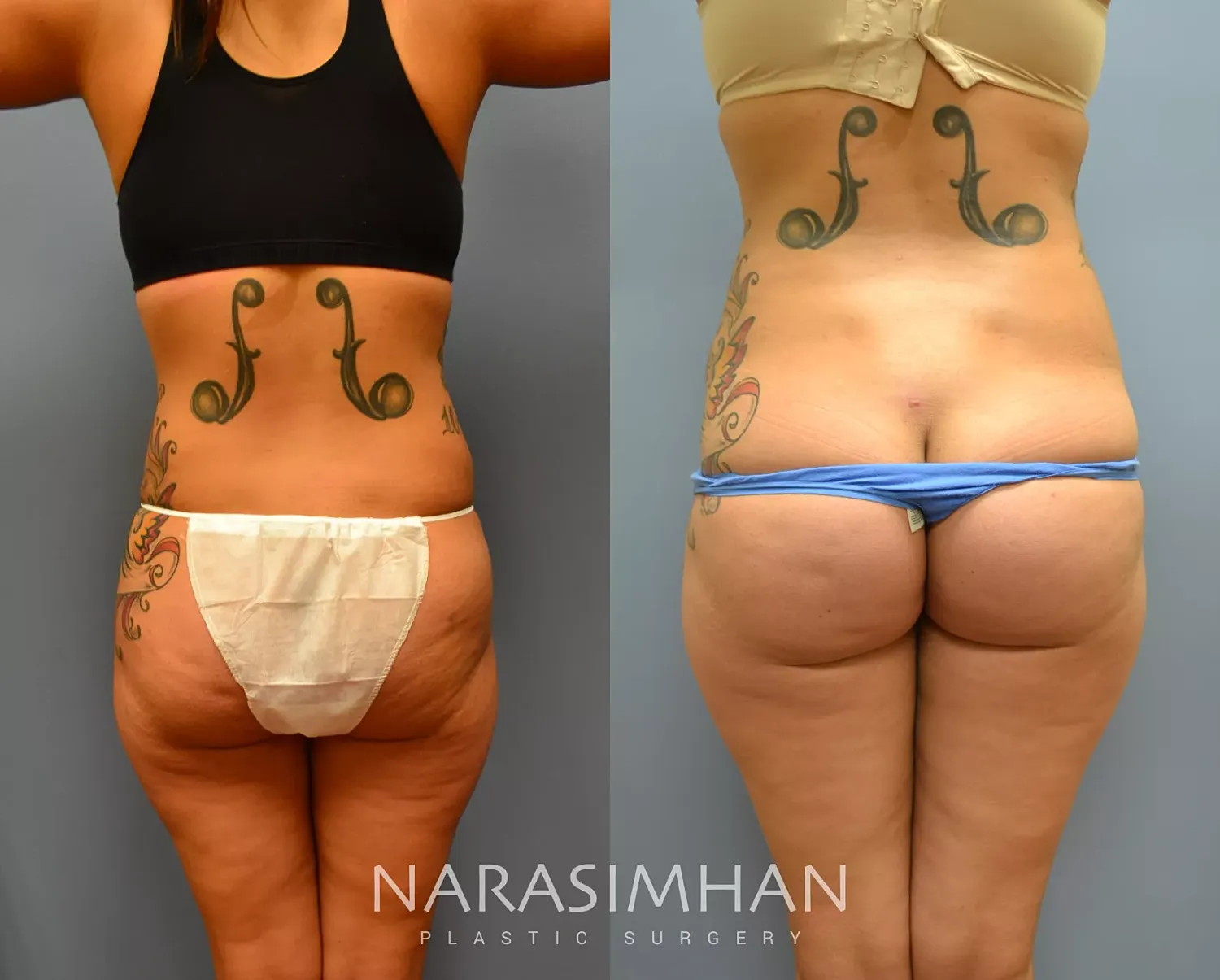 Body Contouring Before & After
