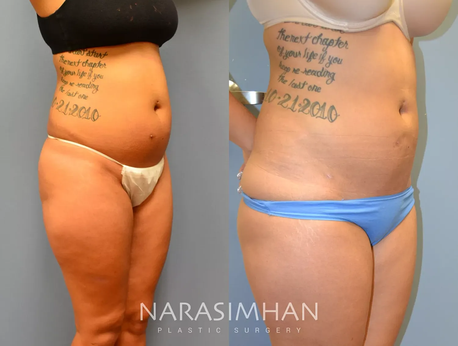 Body Contouring Before & After