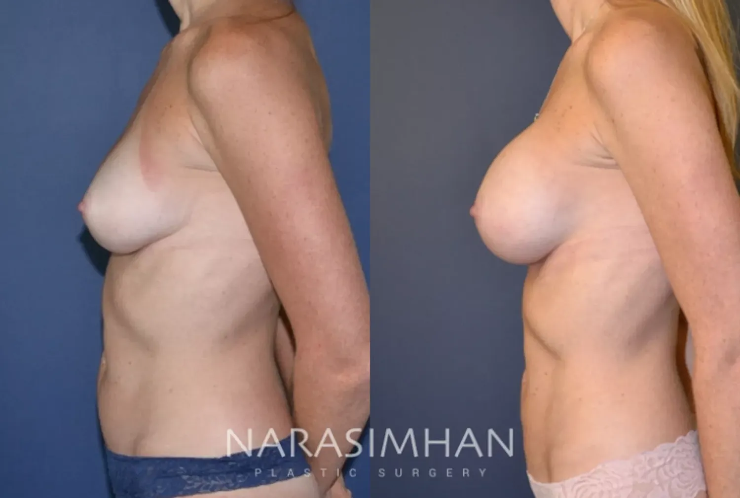 Body Contouring Before & After