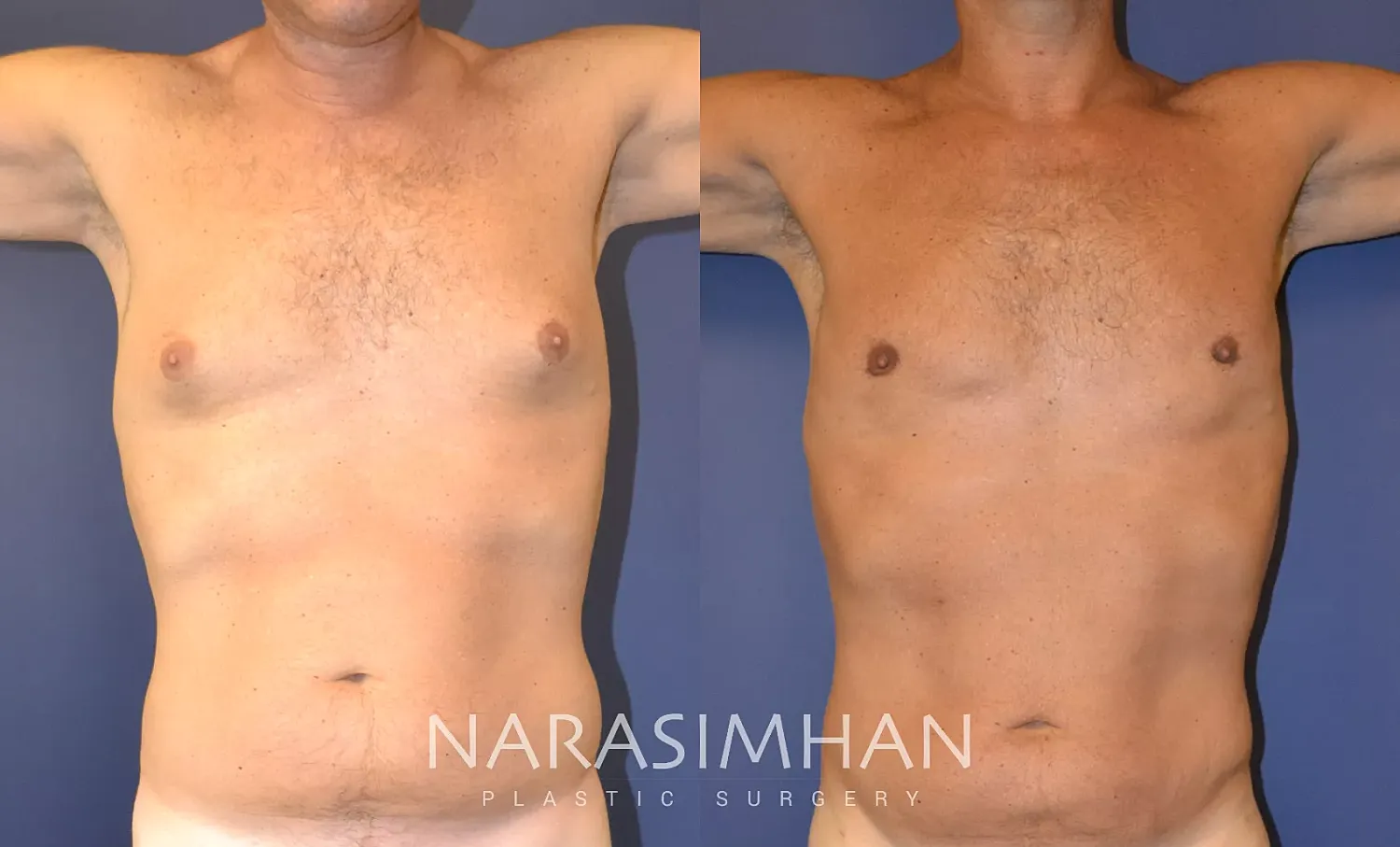Body Contouring Before & After