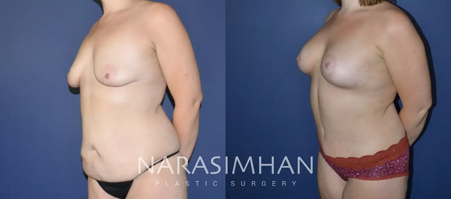 Body Contouring Before & After