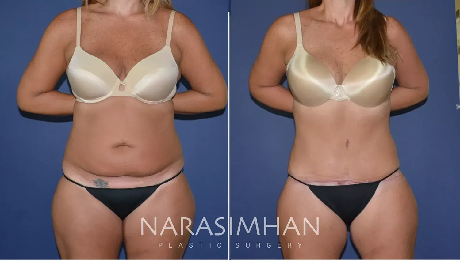Body Contouring Before & After