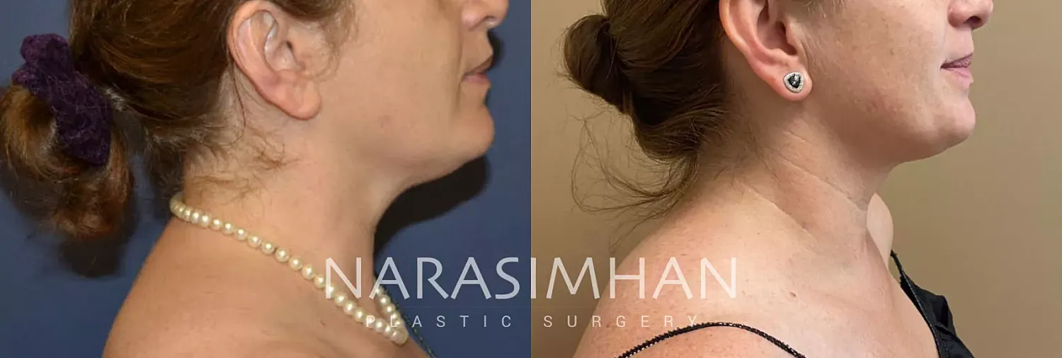 Body Contouring Before & After