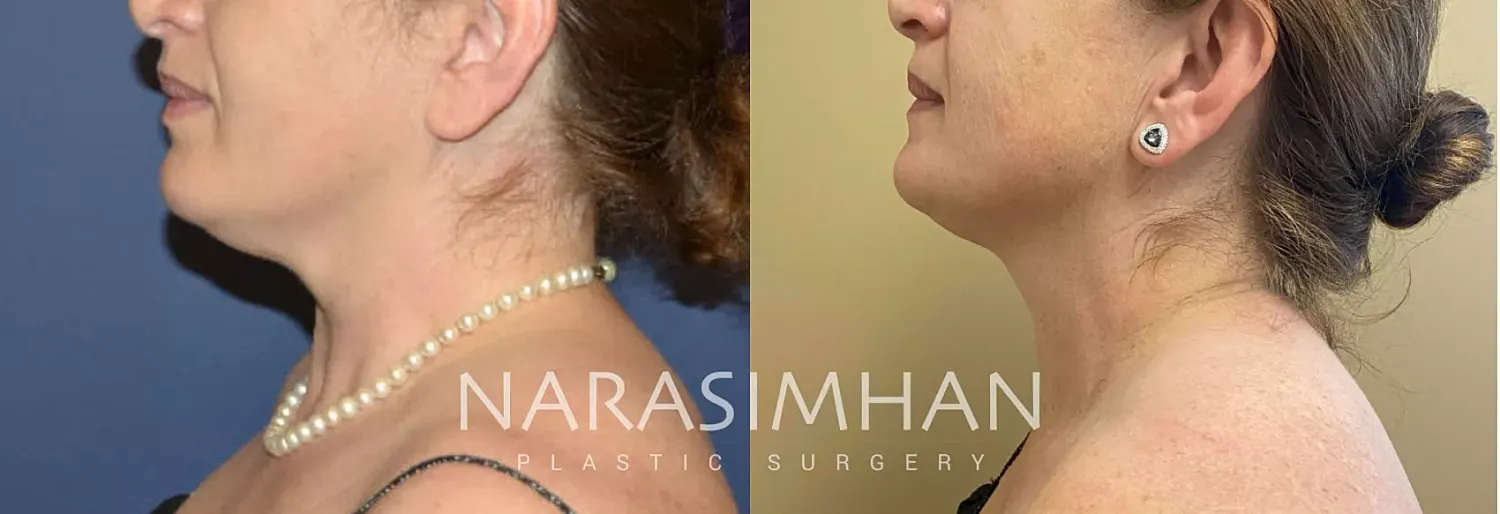 Body Contouring Before & After