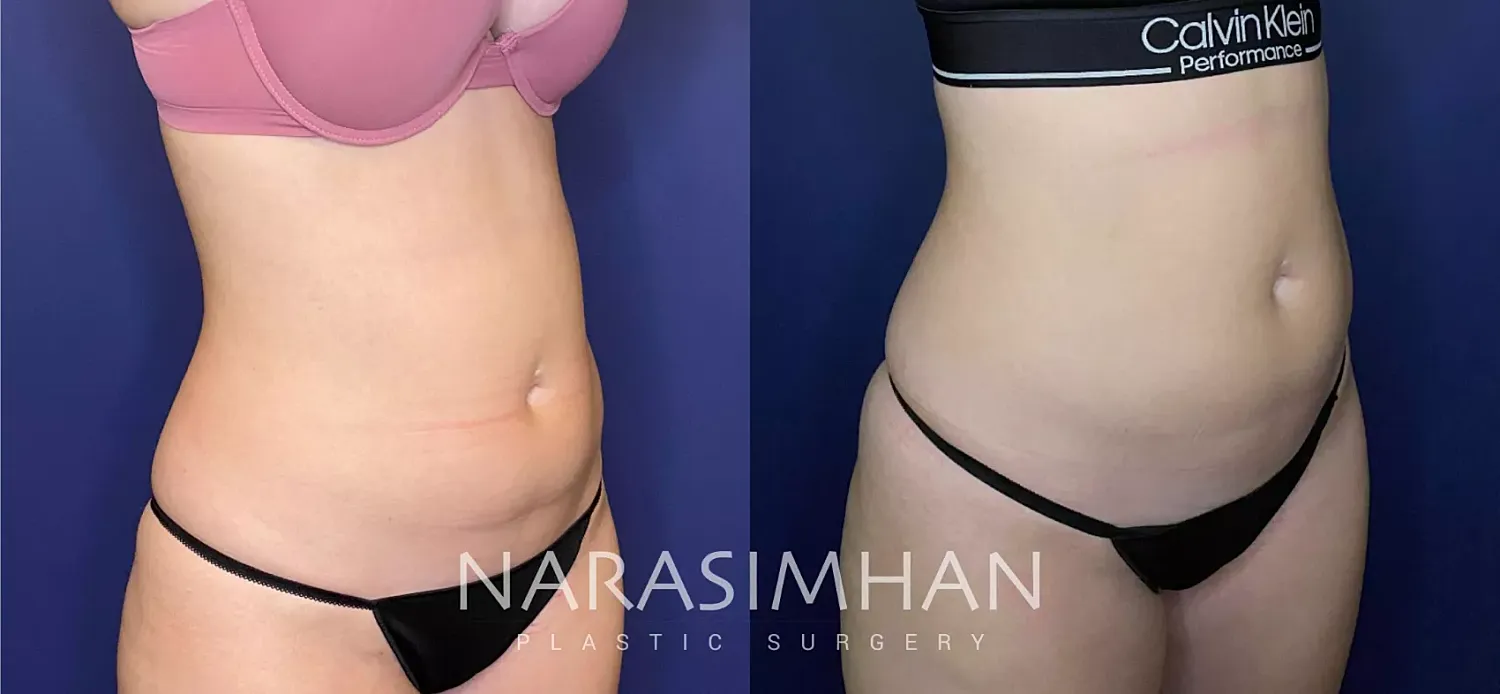 Body Contouring Before & After