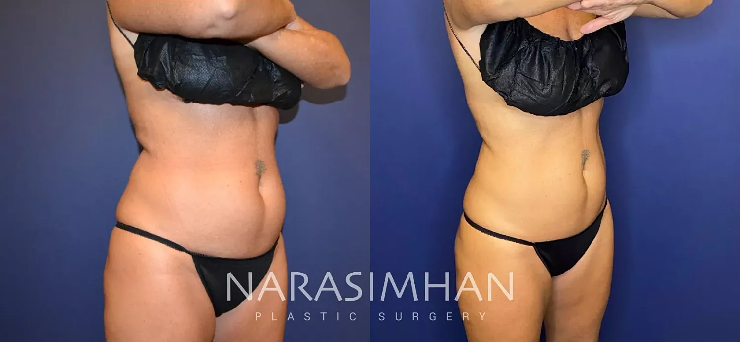 Body Contouring Before & After