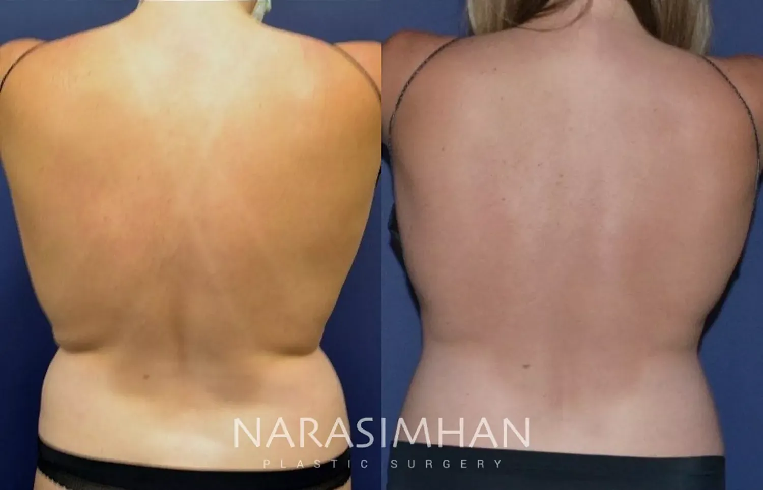 Body Contouring Before & After