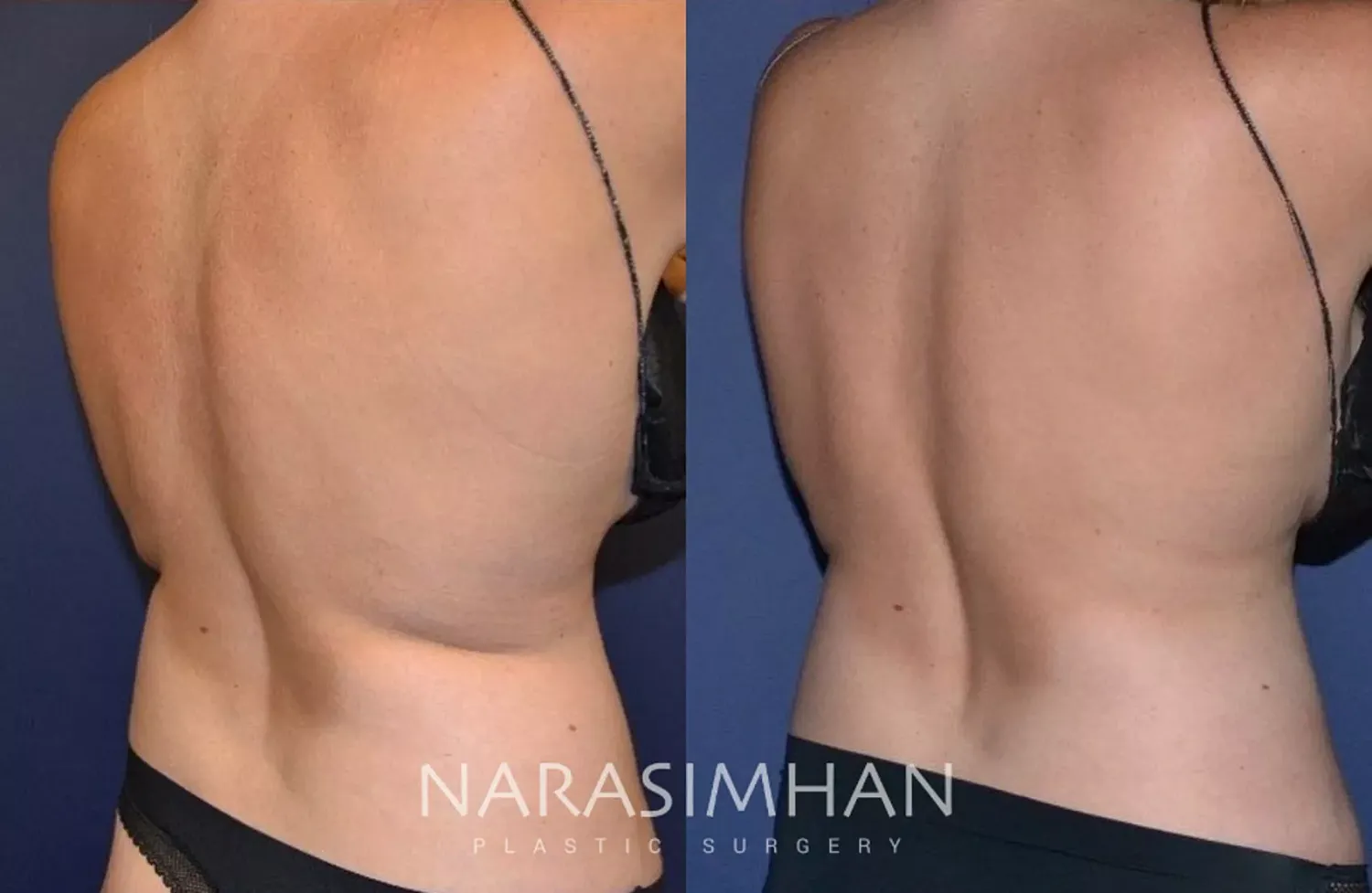 Body Contouring Before & After
