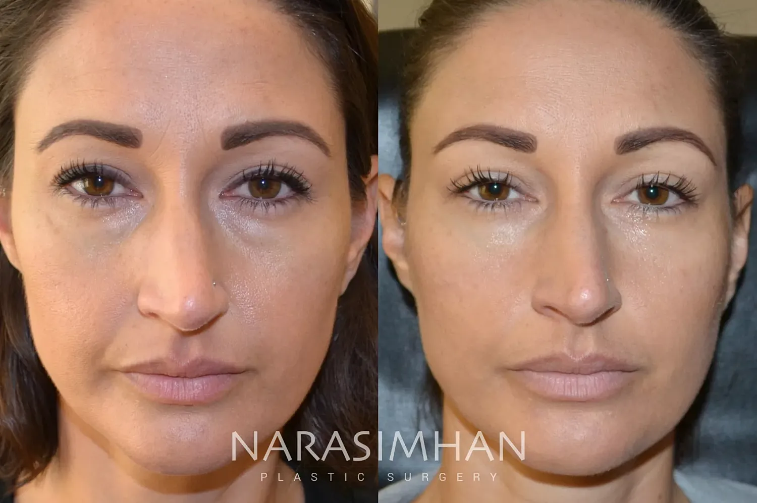 Dermal Filler Before & After